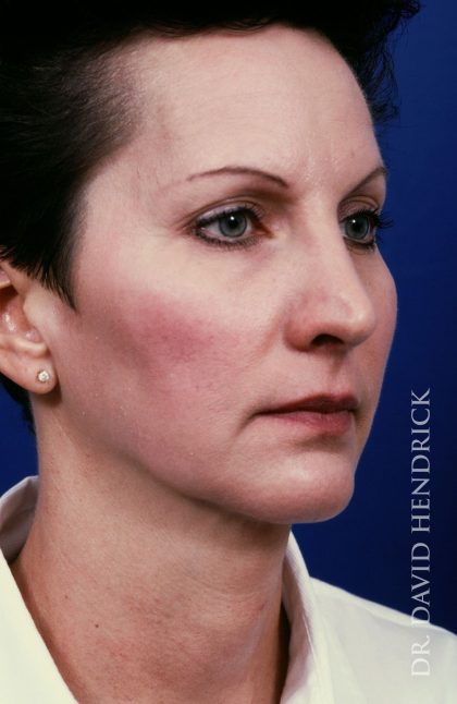 Face Implants Before & After Patient #8885