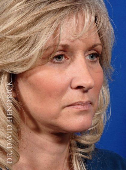 Deep Plane Facelift Before & After Patient #8974