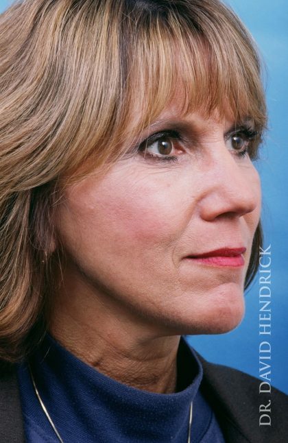 Facelift Before & After Patient #8895