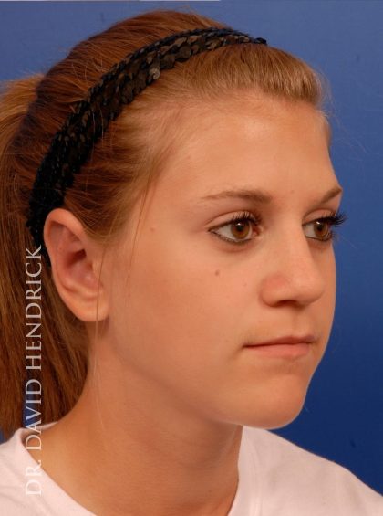 Otoplasty Before & After Patient #8988