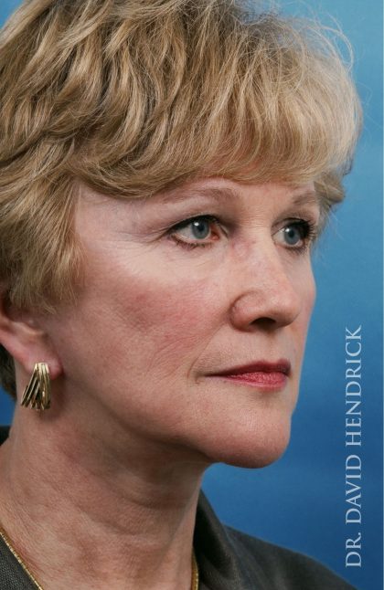 Facelift Before & After Patient #8903