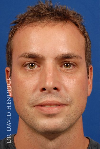 Rhinoplasty Before & After Patient #8995