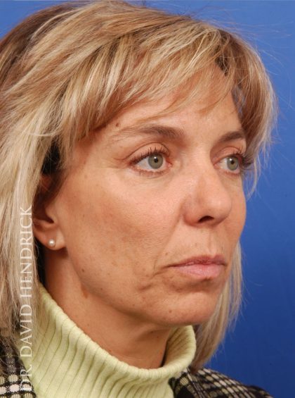 Deep Plane Facelift Before & After Patient #9002