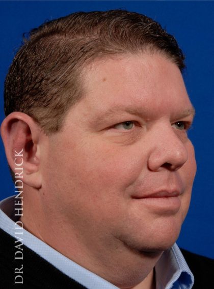 Otoplasty Before & After Patient #9007