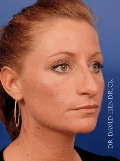 Rhinoplasty Before & After Patient #8931