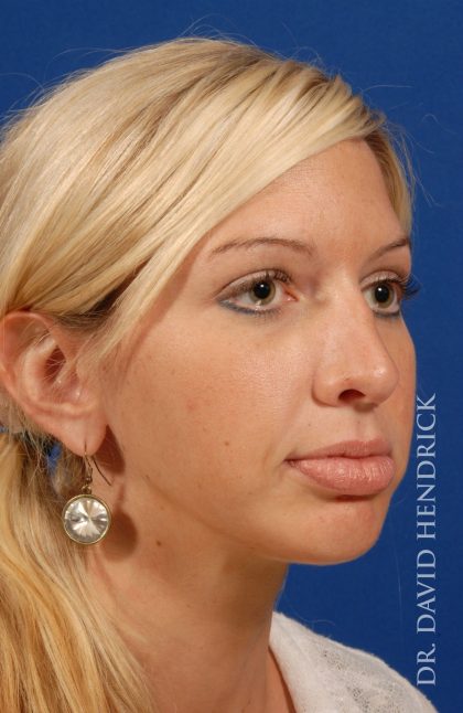 Face Implants Before & After Patient #8912