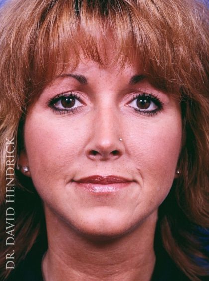 Rhinoplasty Before & After Patient #9019