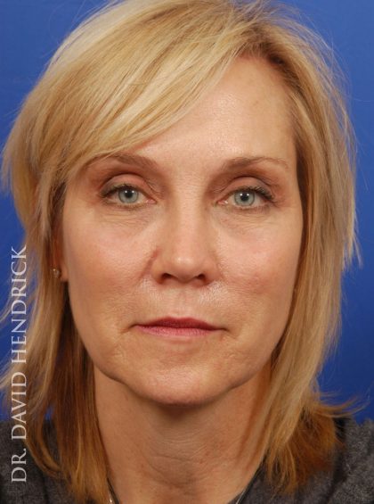 Deep Plane Facelift Before & After Patient #9026