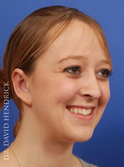 Otoplasty Before & After Patient #9031