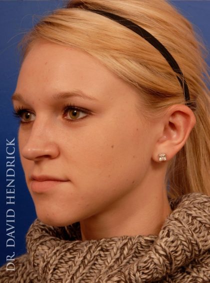 Otoplasty Before & After Patient #9038