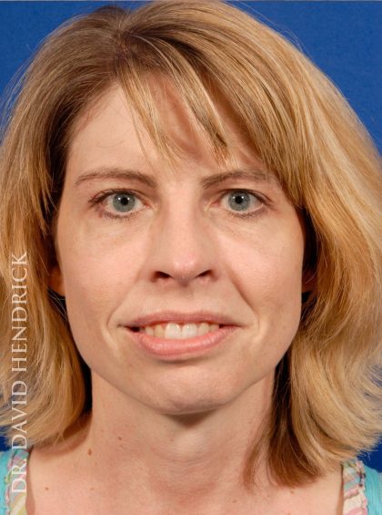 Rhinoplasty Before & After Patient #9045