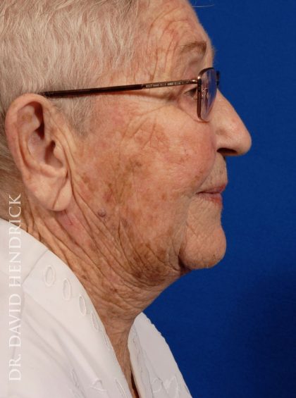 Neck Lift Before & After Patient #9052