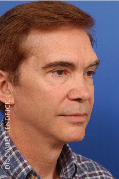 Facelift Before & After Patient #8873