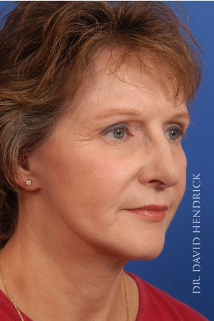 Facelift Before & After Patient #8847