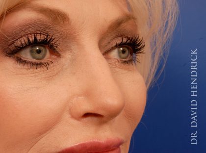 Deep Plane Facelift Before & After Patient #8936