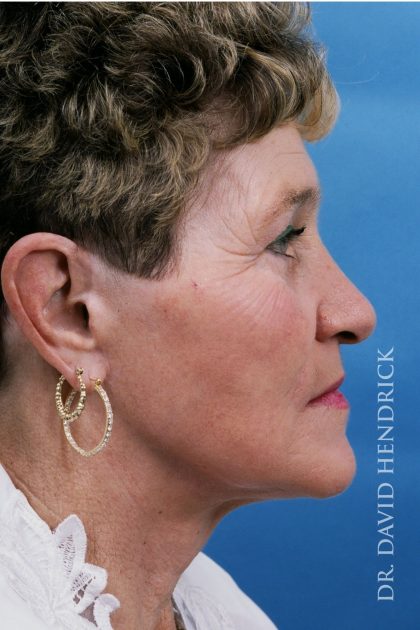 Facelift Before & After Patient #8840