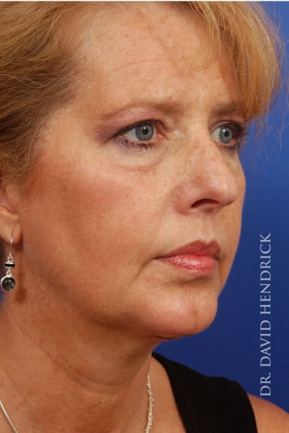 Face Implants Before & After Patient #8829