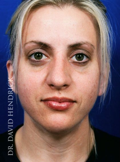 Face Implants Before & After Patient #8890