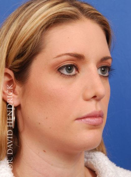 Face Implants Before & After Patient #8875