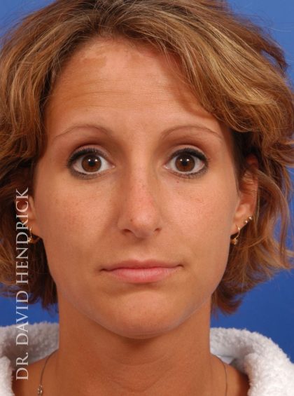 Rhinoplasty Before & After Patient #8941