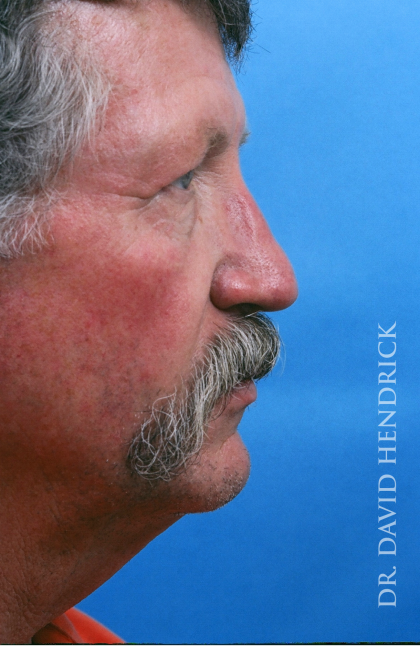 Neck Lift Before & After Patient #9014