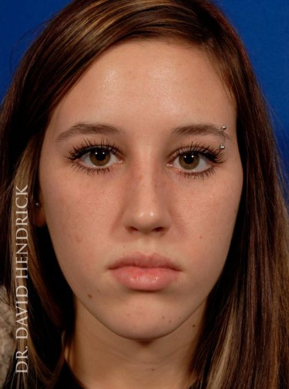 Rhinoplasty Before & After Patient #8948