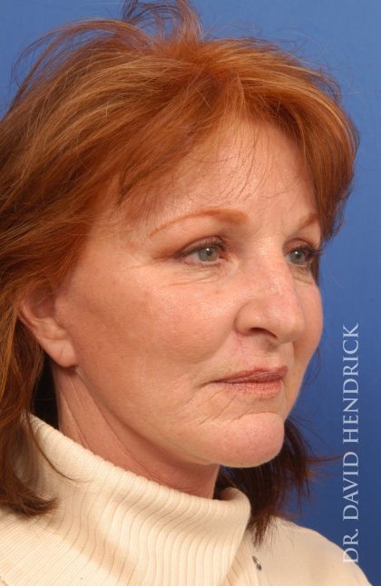 Facelift Before & After Patient #8859