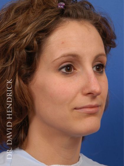 Rhinoplasty Before & After Patient #8941