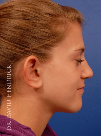 Otoplasty Before & After Patient #8988