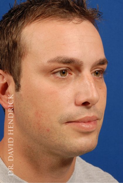 Rhinoplasty Before & After Patient #8995