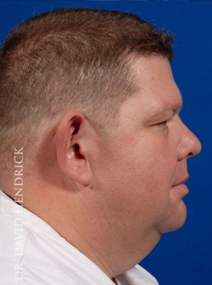 Otoplasty Before & After Patient #9007