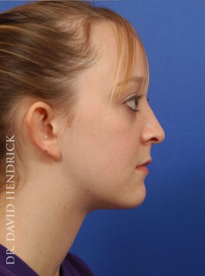 Otoplasty Before & After Patient #9031