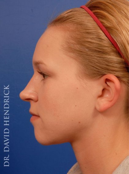 Otoplasty Before & After Patient #9038