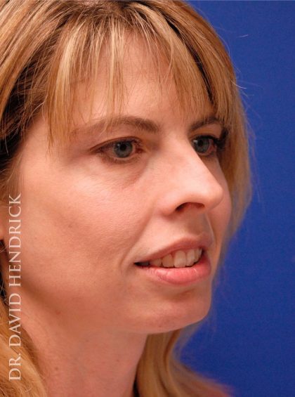 Rhinoplasty Before & After Patient #9045