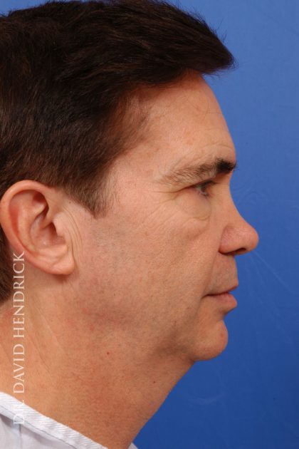 Facelift Before & After Patient #8873