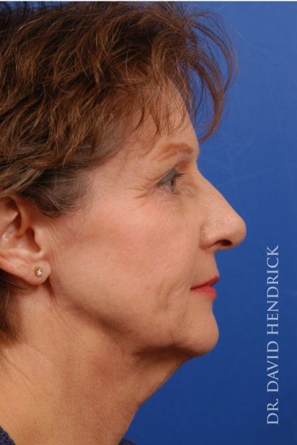 Facelift Before & After Patient #8847