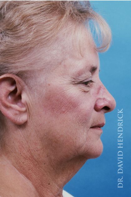 Facelift Before & After Patient #8819