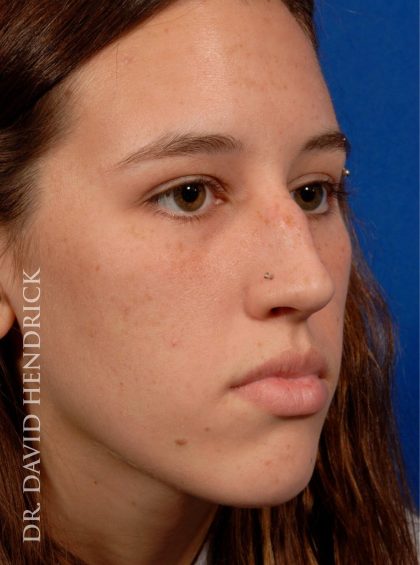 Rhinoplasty Before & After Patient #8948