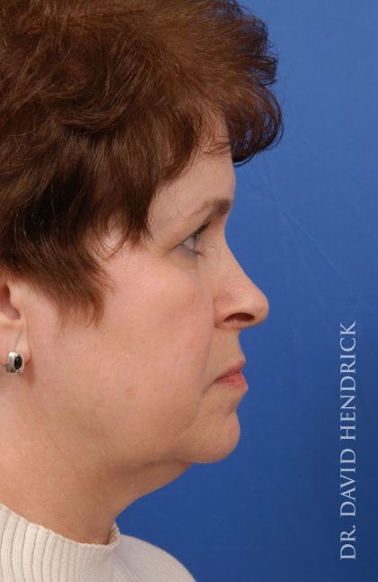 Facelift Before & After Patient #8857