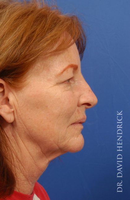Facelift Before & After Patient #8859