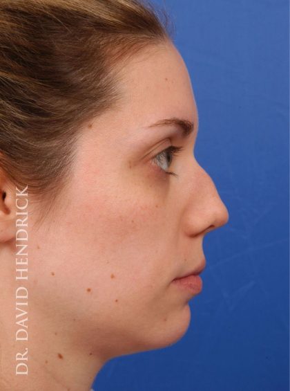 Chin Implant Before & After Patient #8955