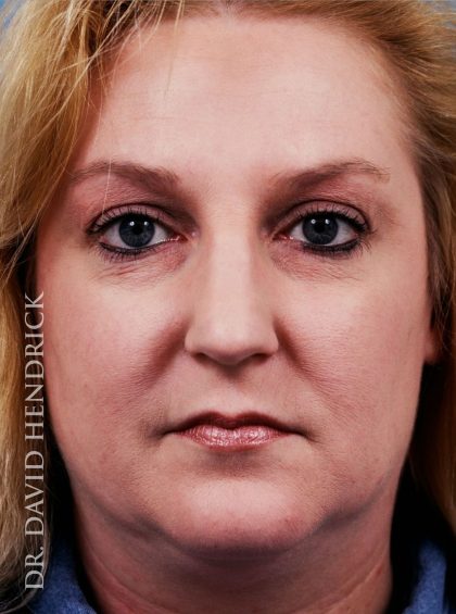 Rhinoplasty Before & After Patient #8967