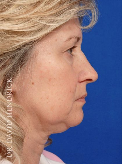 Deep Plane Facelift Before & After Patient #8974