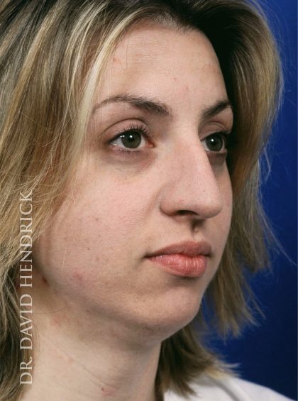 Chin Implant Before & After Patient #8981