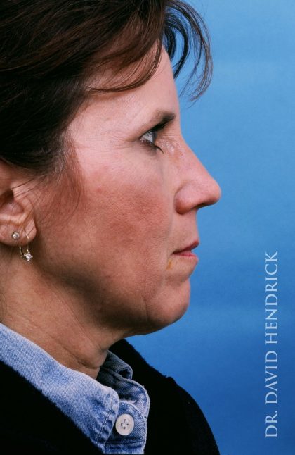 Facelift Before & After Patient #8895