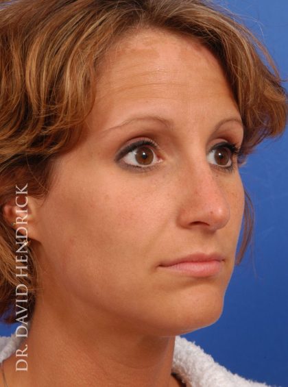 Rhinoplasty Before & After Patient #8941