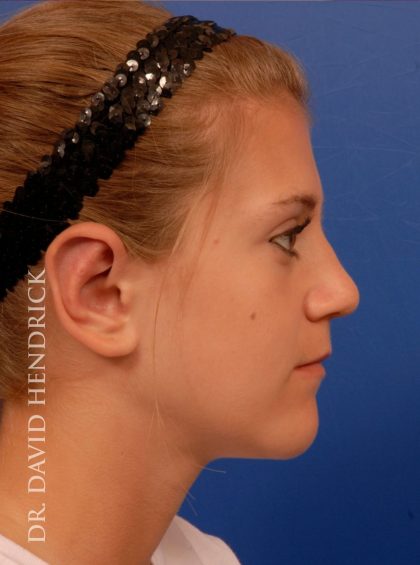 Otoplasty Before & After Patient #8988