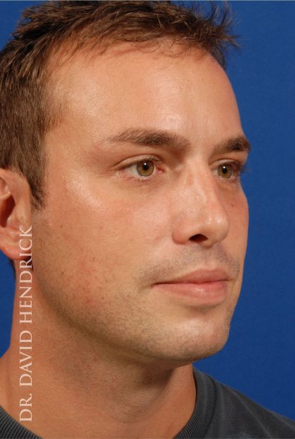 Rhinoplasty Before & After Patient #8995