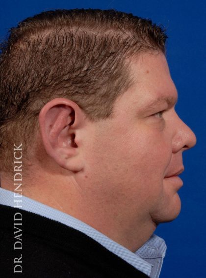 Otoplasty Before & After Patient #9007
