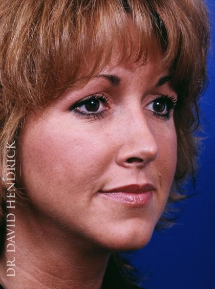 Rhinoplasty Before & After Patient #9019